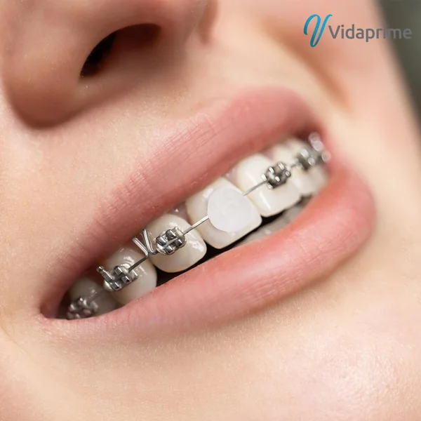 Cera Dental para Brackets Ortodoncia | Pack 10 Estuches